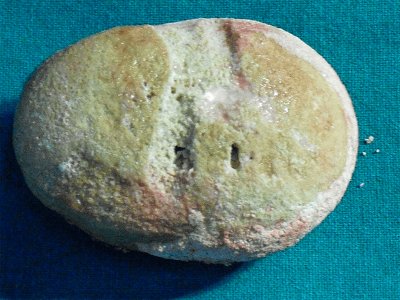 kidney stone disease 1